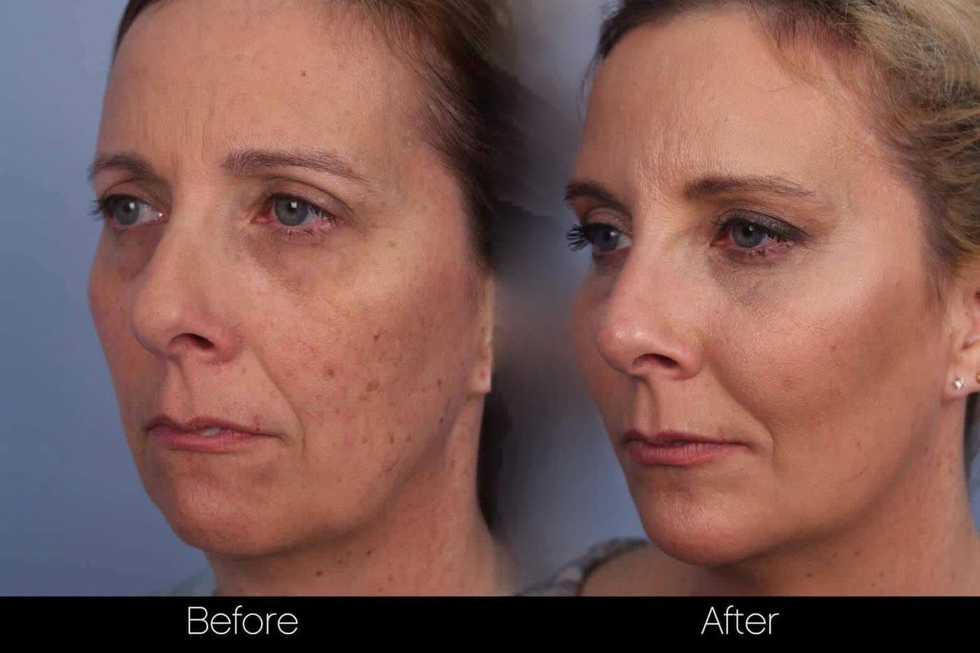 Fractional Erbium Laser - Before and After Gallery – Photo 42