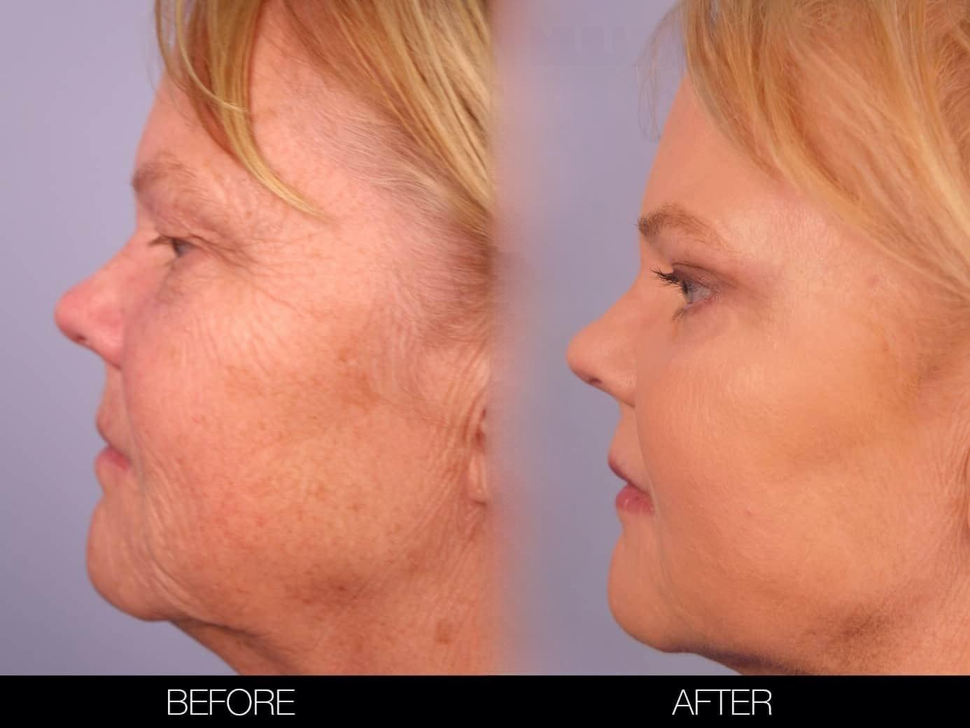 Fractional Erbium Laser - Before and After Gallery – Photo 31