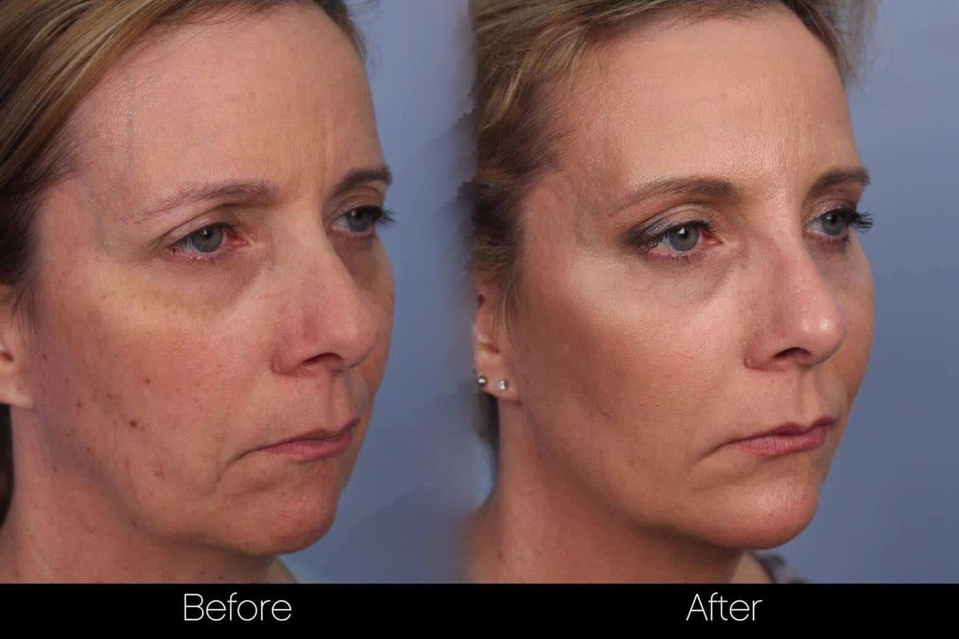 Fractional Erbium Laser - Before and After Gallery – Photo 44