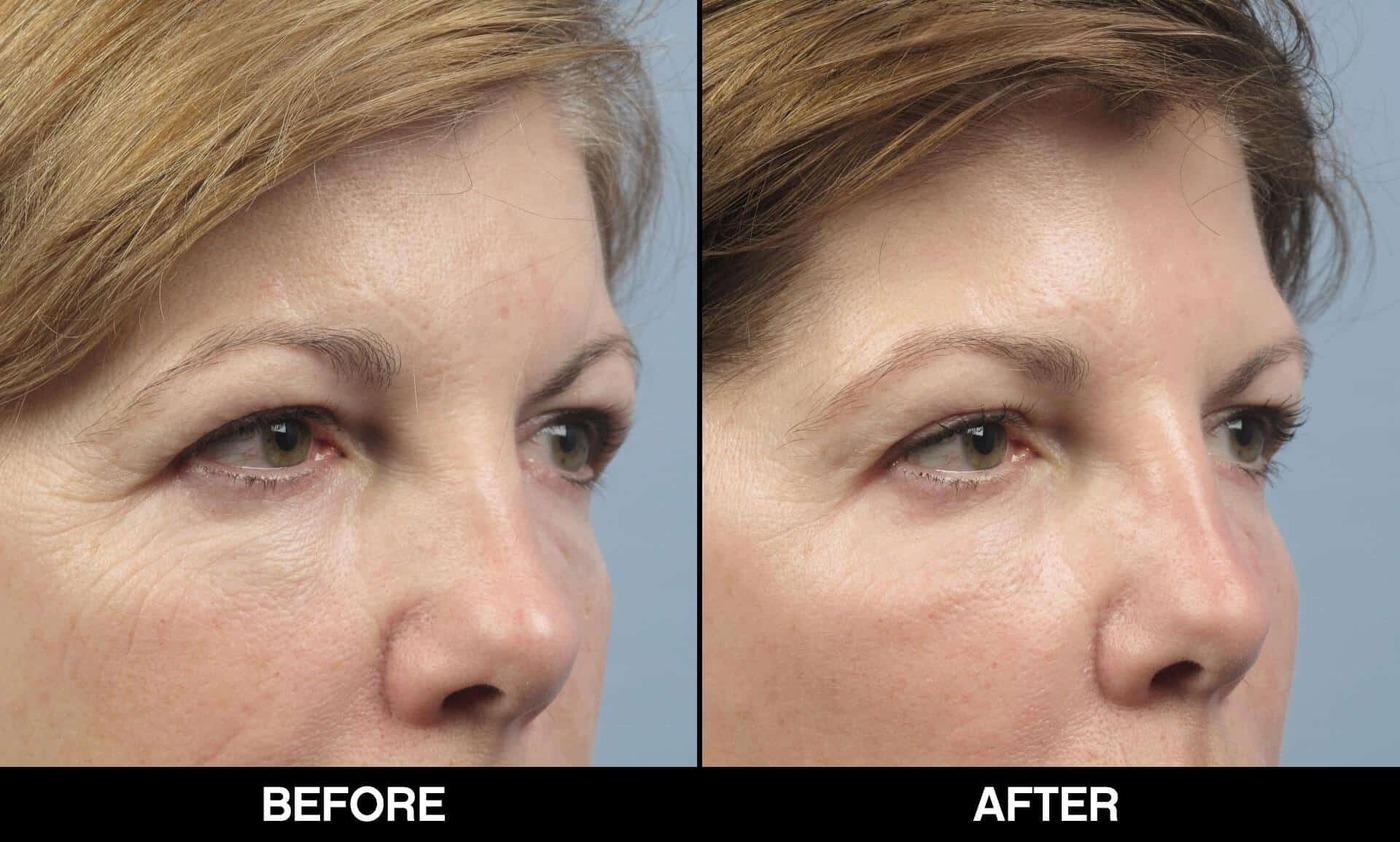 Fractional Erbium Laser - Before and After Gallery – Photo 62