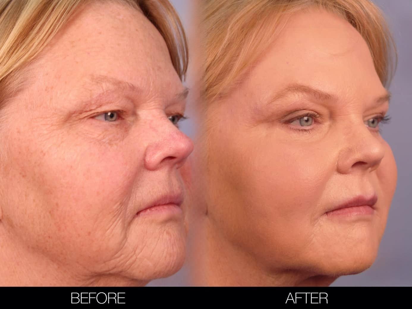 Fractional Erbium Laser - Before and After Gallery – Photo 32