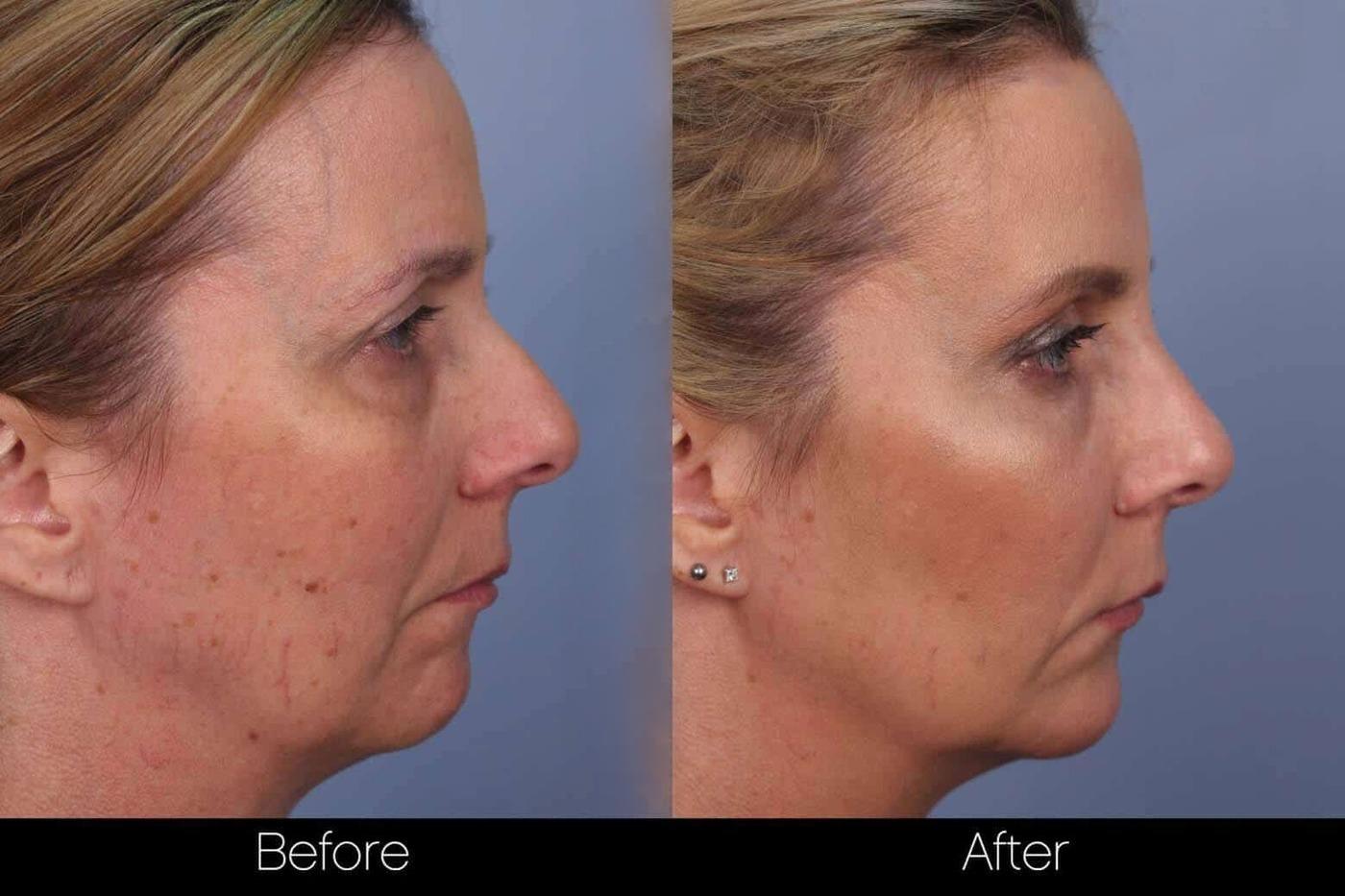 Fractional Erbium Laser - Before and After Gallery – Photo 47