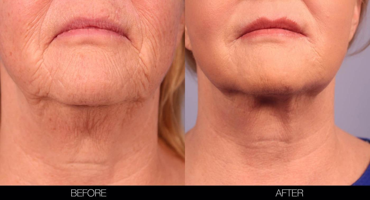 Fractional Erbium Laser - Before and After Gallery – Photo 33