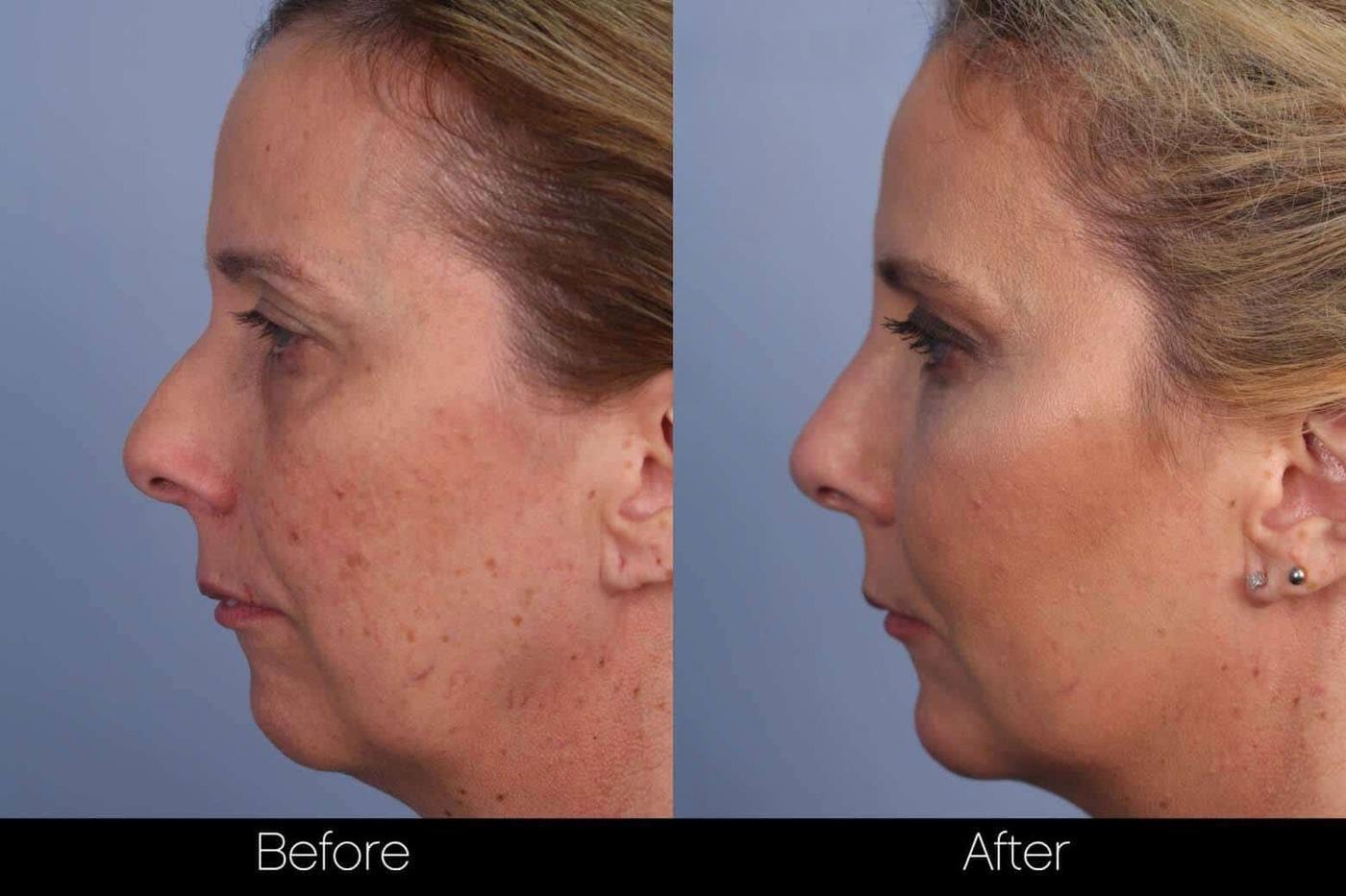 Fractional Erbium Laser - Before and After Gallery – Photo 60