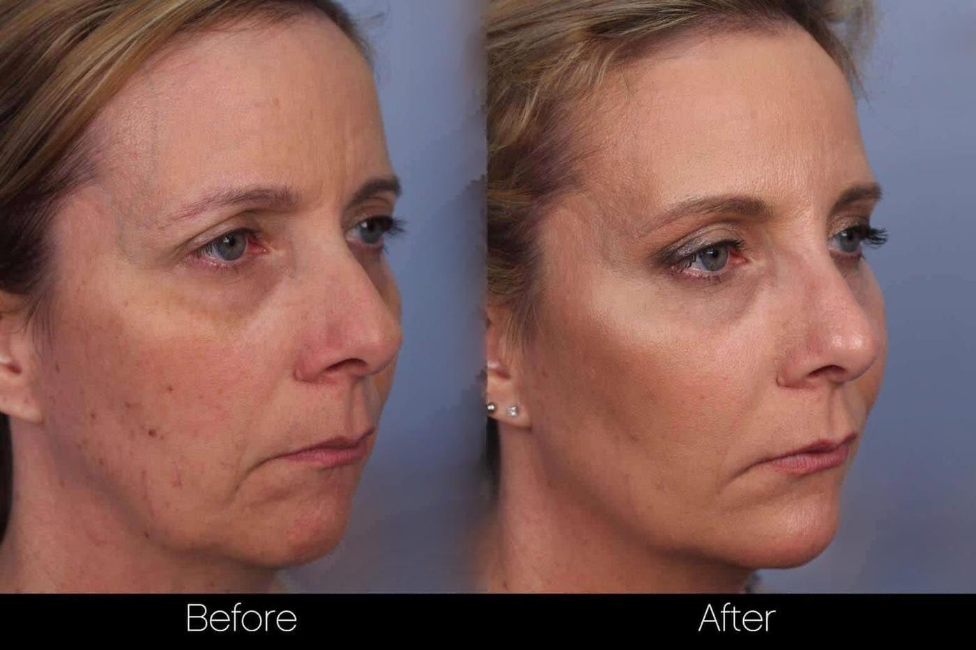 Fractional Erbium Laser - Before and After Gallery – Photo 61