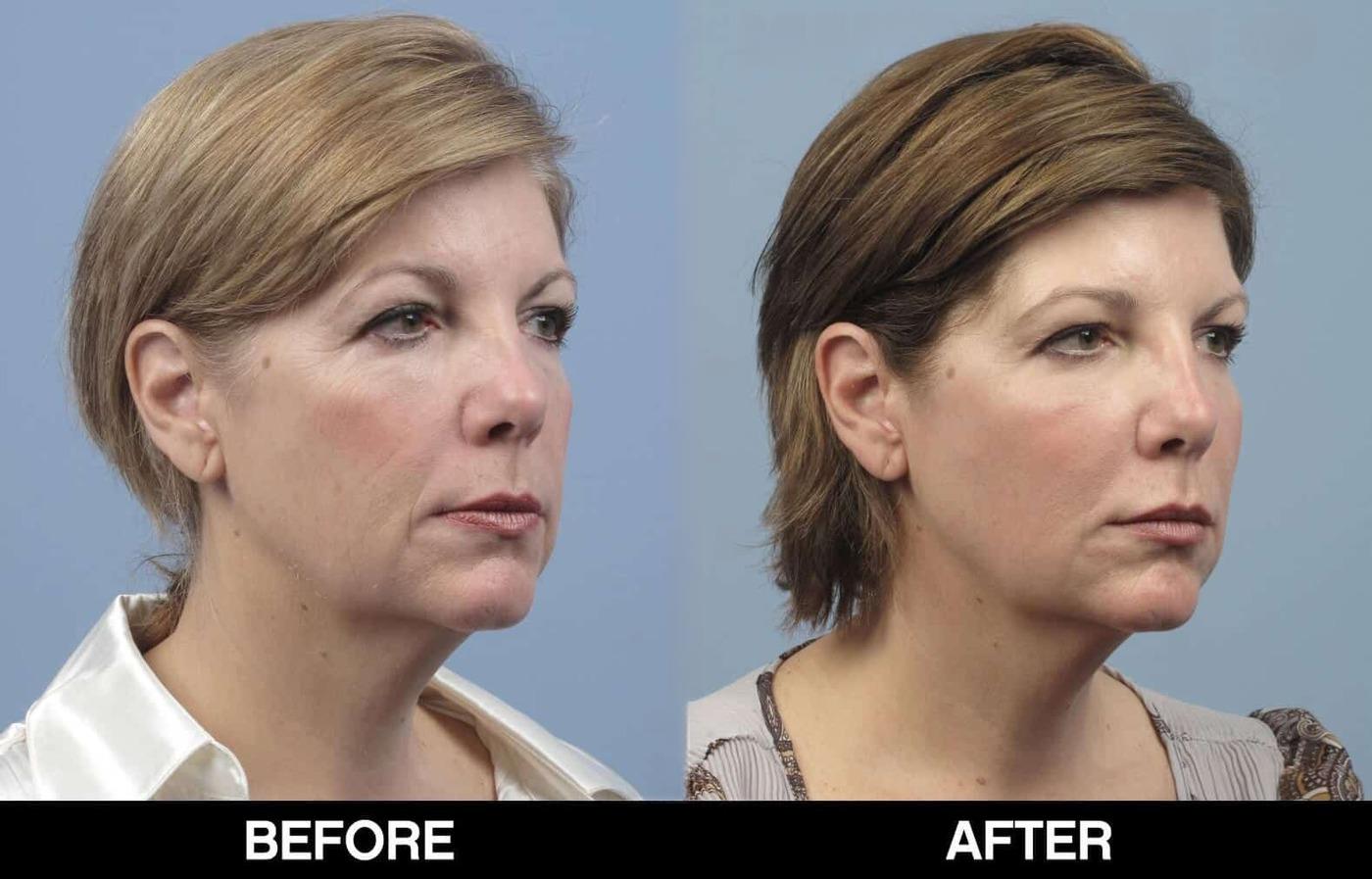 Fractional Erbium Laser - Before and After Gallery – Photo 68