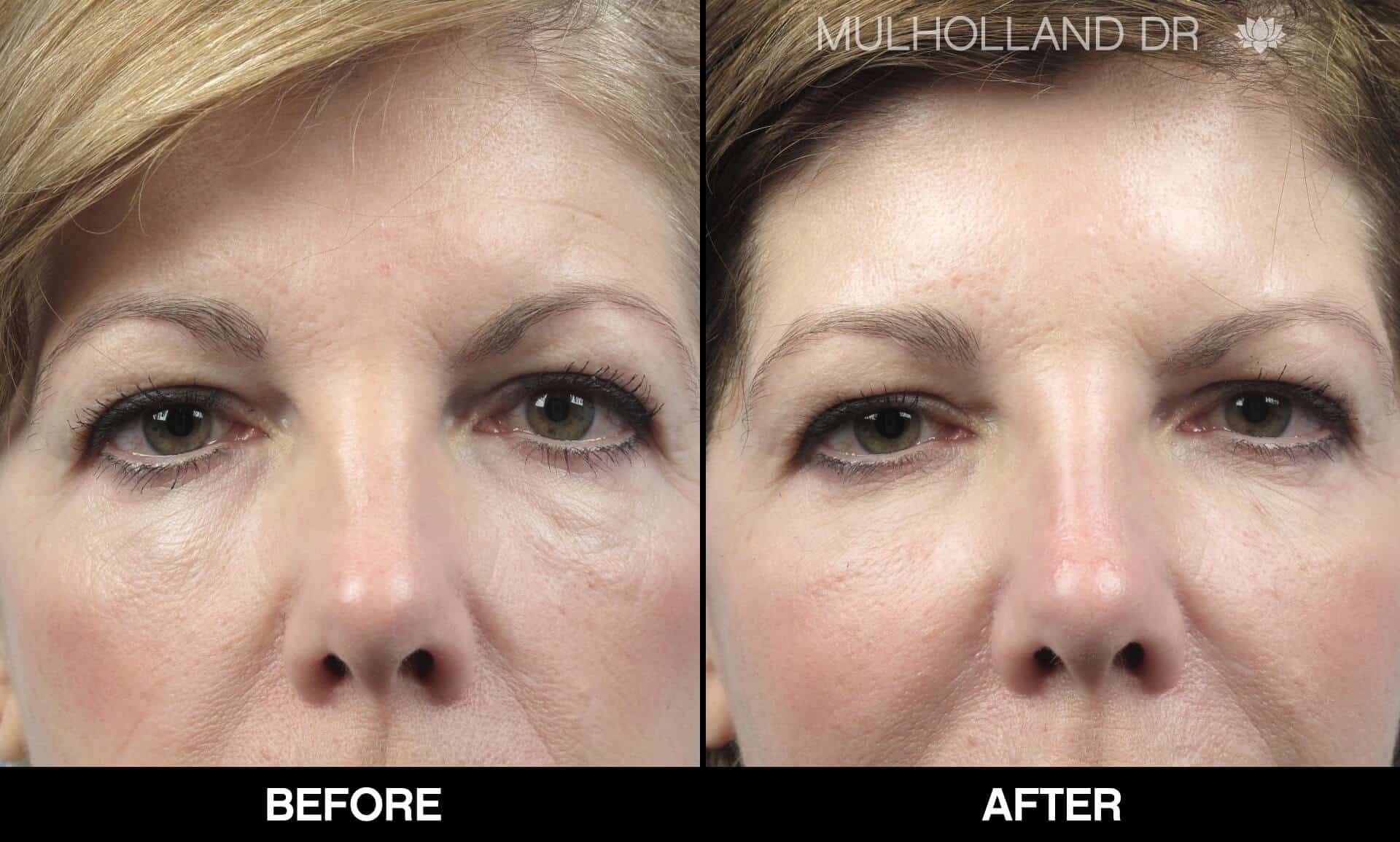 Fractional Erbium Laser - Before and After Gallery – Photo 59