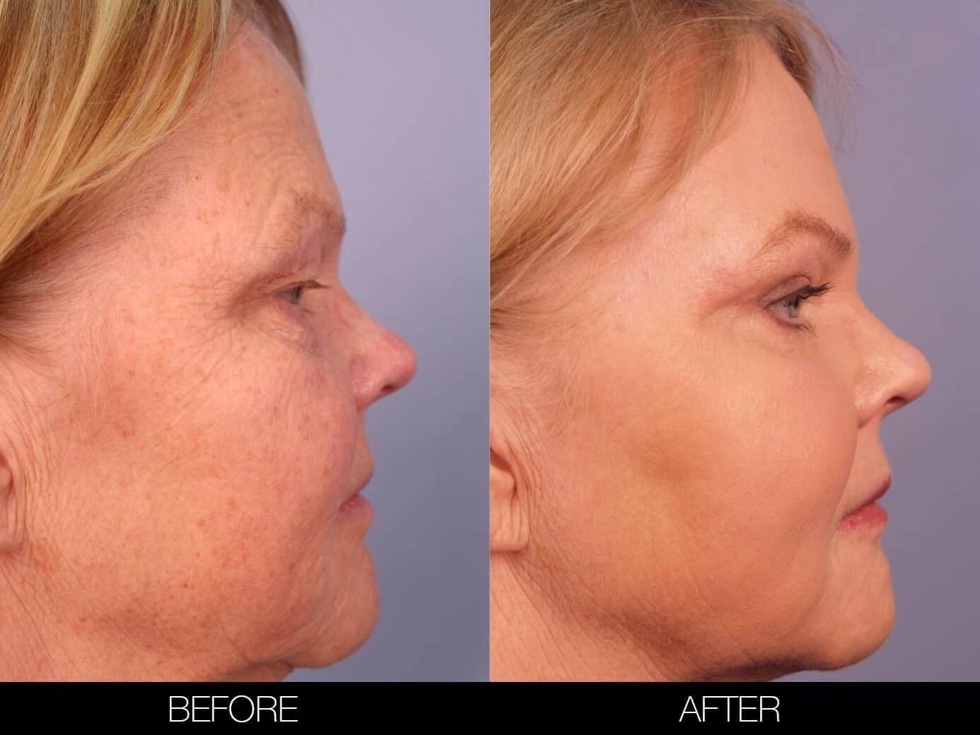 Fractional Erbium Laser - Before and After Gallery – Photo 29