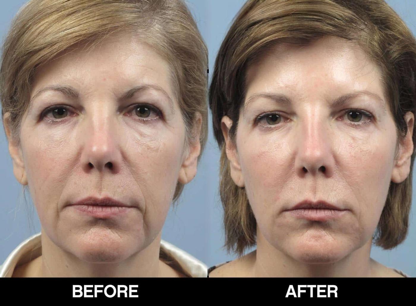 Fractional Erbium Laser - Before and After Gallery – Photo 61