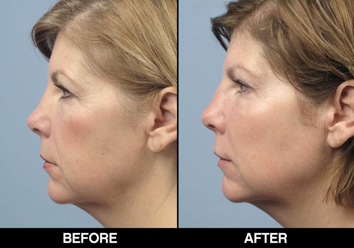 Fractional Erbium Laser - Before and After Gallery – Photo 64