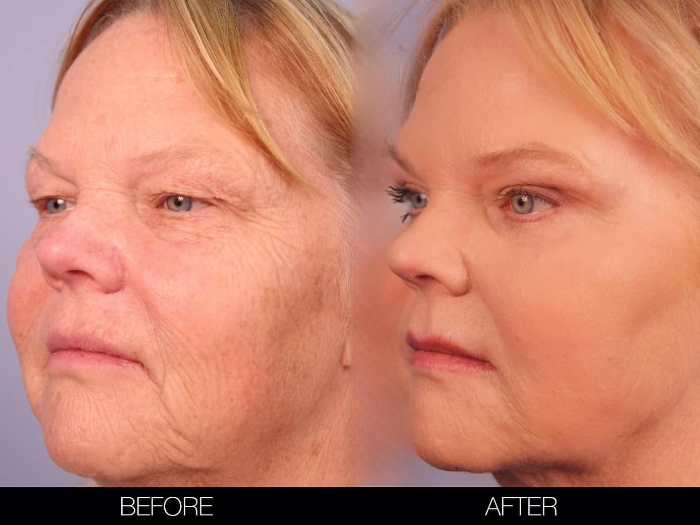 Fractional Erbium Laser - Before and After Gallery – Photo 34