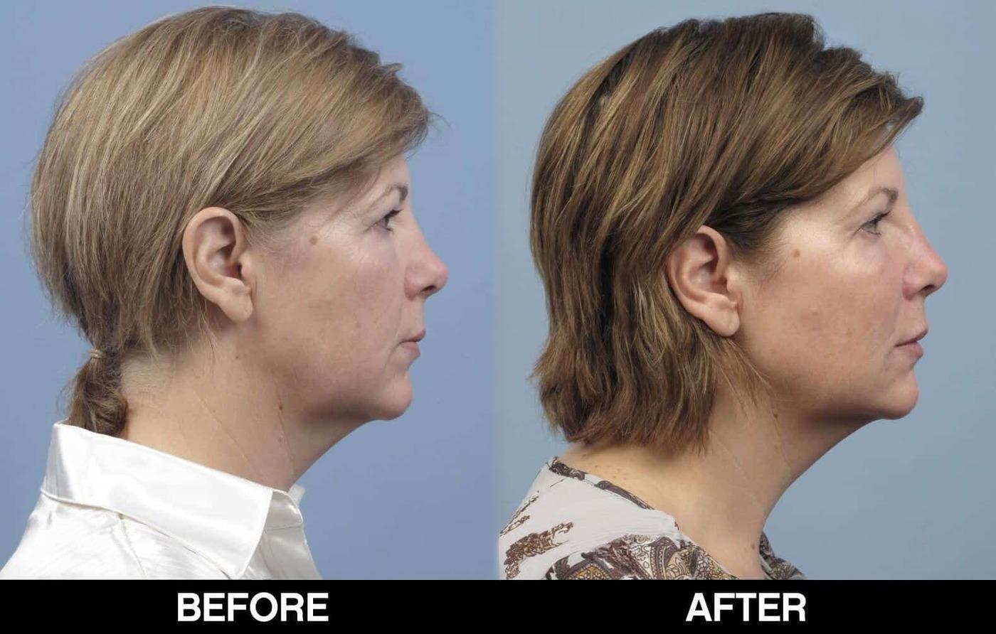 Fractional Erbium Laser - Before and After Gallery – Photo 76