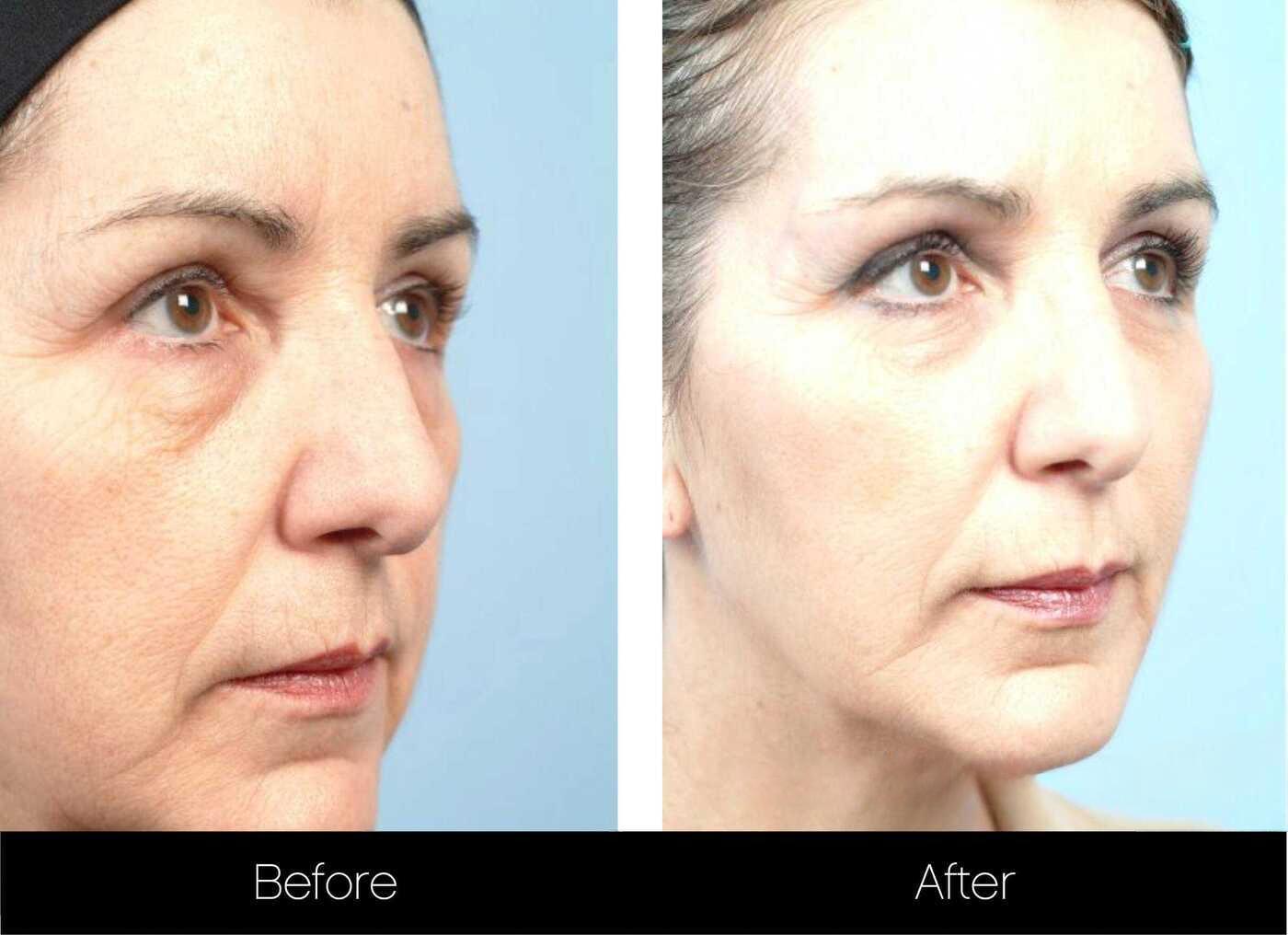 Fractional Erbium Laser - Before and After Gallery – Photo 79