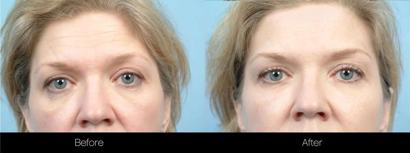 Fractional Erbium Laser - Before and After Gallery – Photo 81