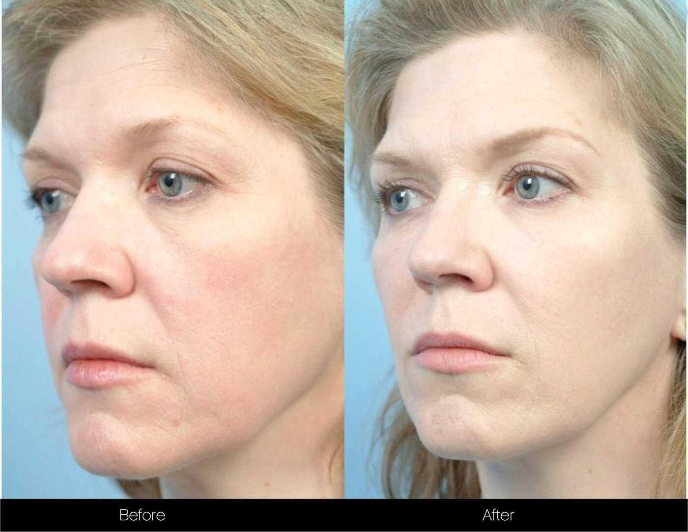 Fractional Erbium Laser - Before and After Gallery – Photo 82