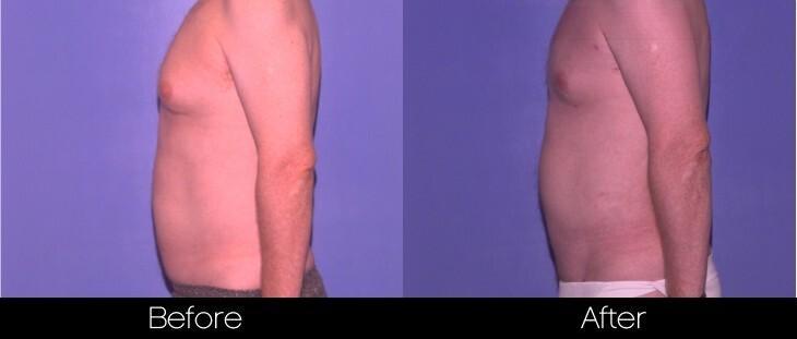 Smart Lipo - Before and After Gallery – Photo 79