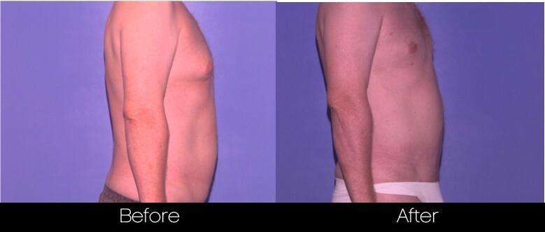 Smart Lipo - Before and After Gallery – Photo 80