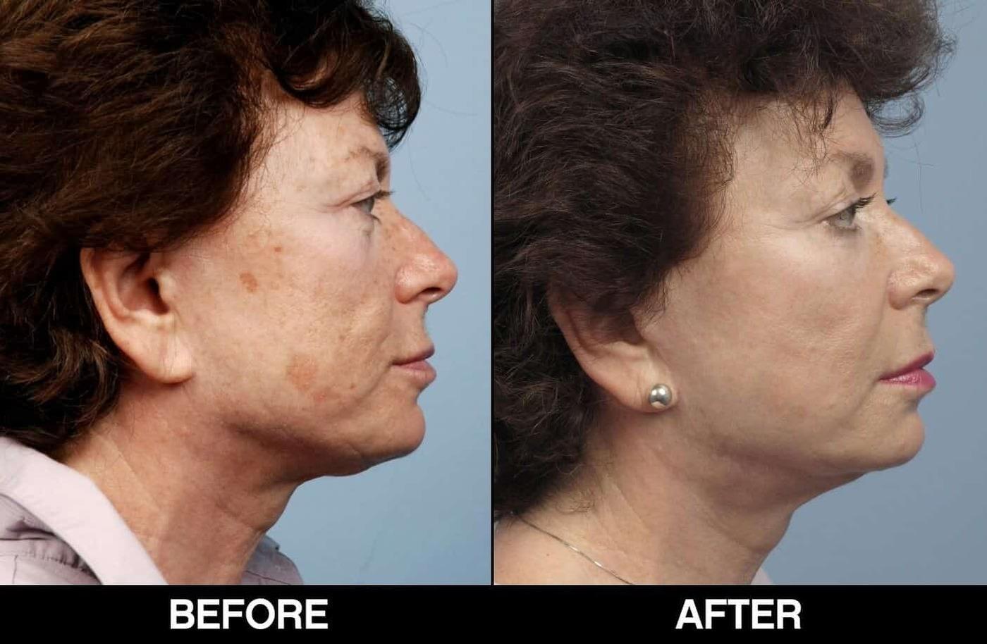 Fractional Erbium Laser - Before and After Gallery – Photo 80