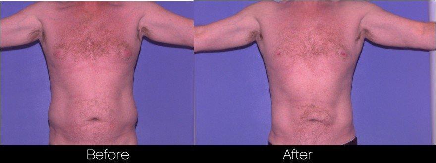 Smart Lipo - Before and After Gallery – Photo 76