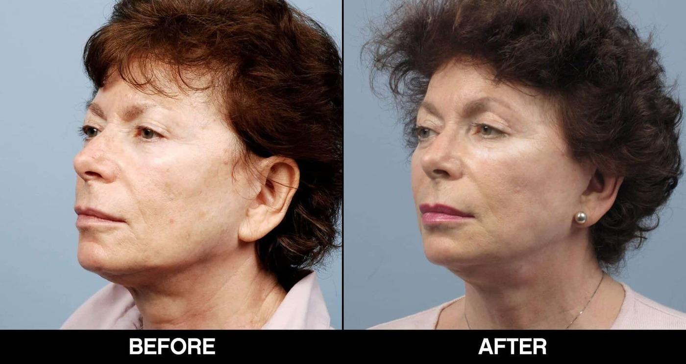 Fractional Erbium Laser - Before and After Gallery – Photo 81