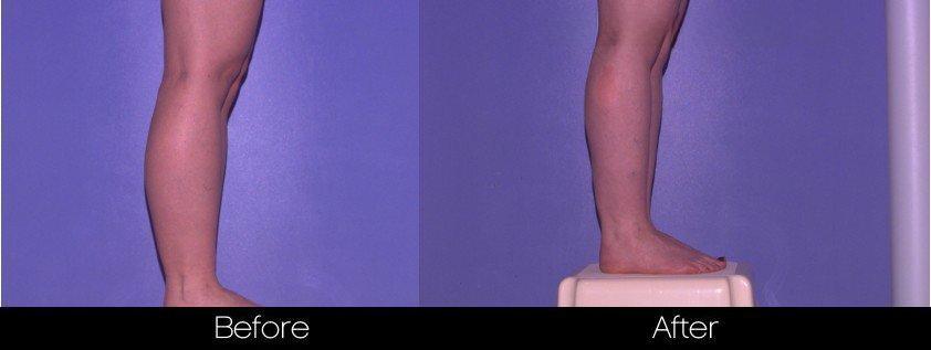 Smart Lipo - Before and After Gallery – Photo 82