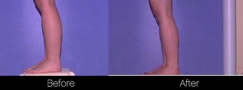 Smart Lipo - Before and After Gallery – Photo 83