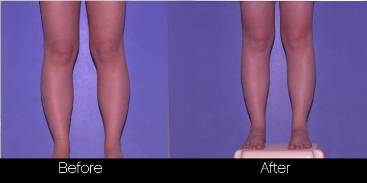 Smart Lipo - Before and After Gallery – Photo 84