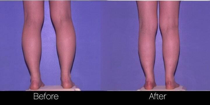 Smart Lipo - Before and After Gallery – Photo 85