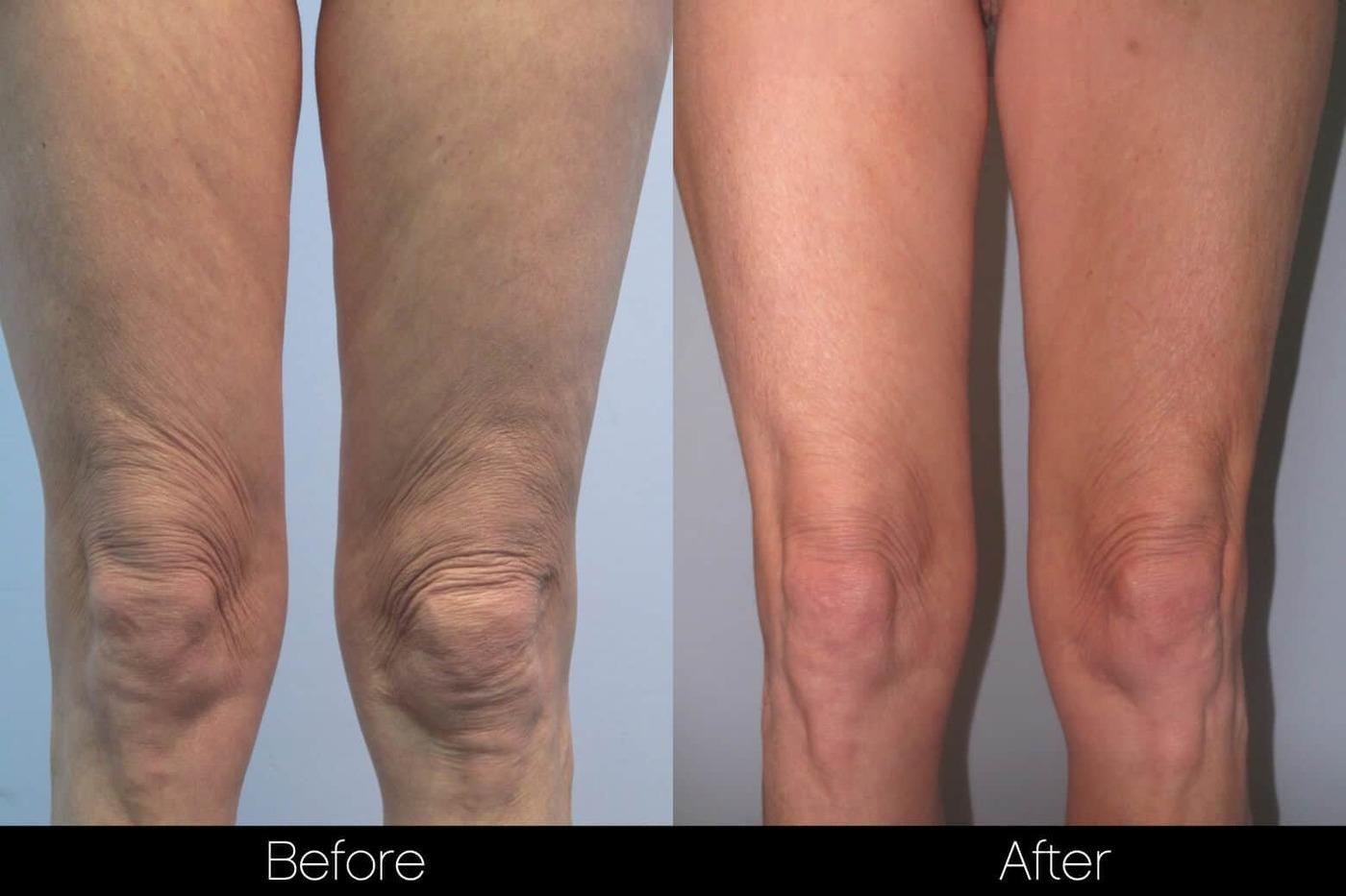 Smart Lipo - Before and After Gallery – Photo 86