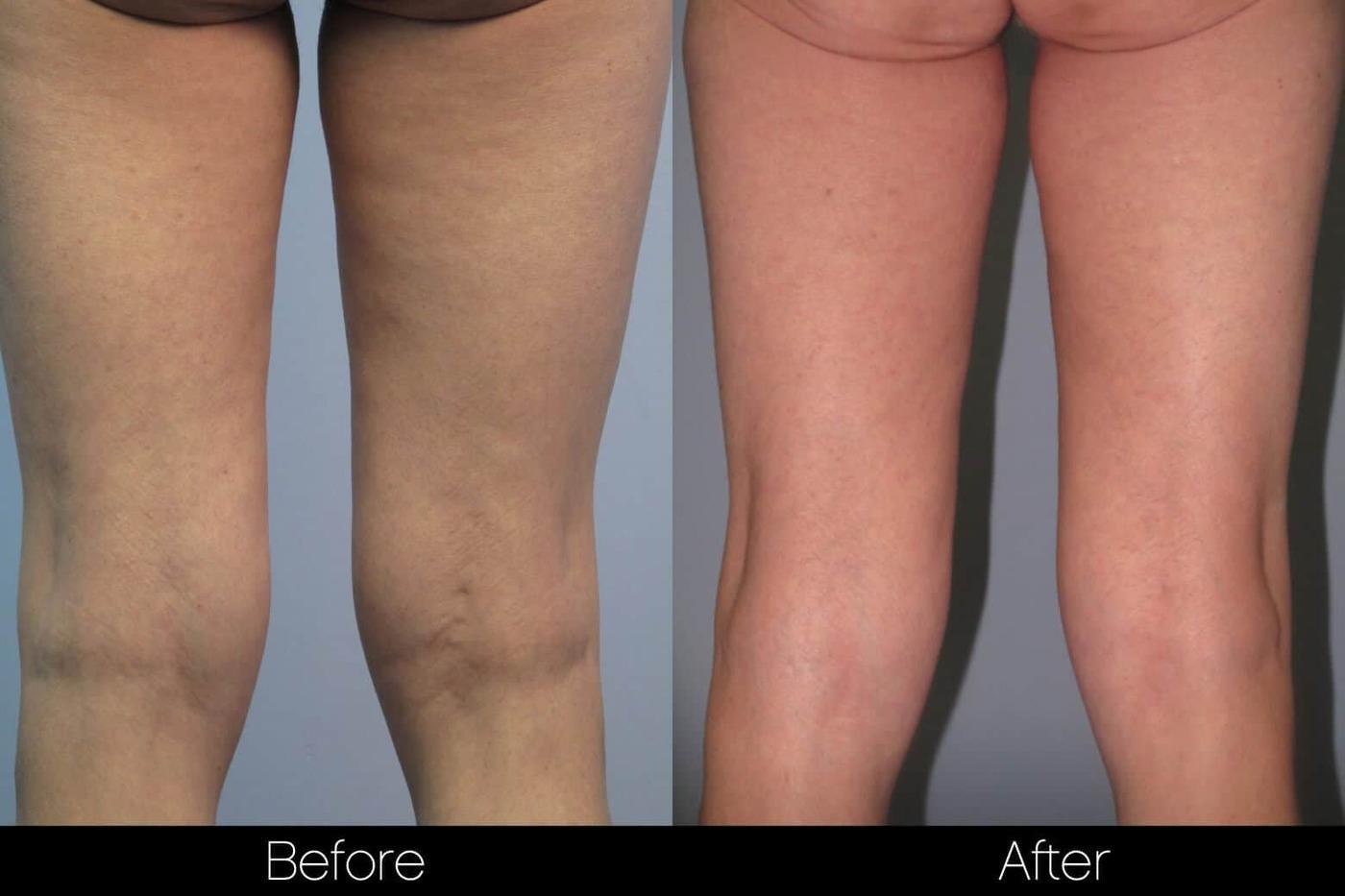 Smart Lipo - Before and After Gallery – Photo 87