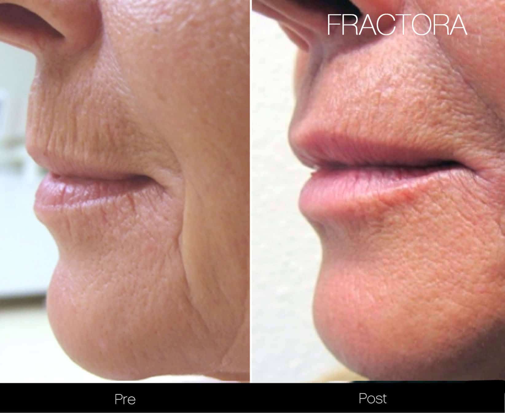 Fractional Erbium Laser - Before and After Gallery – Photo 9
