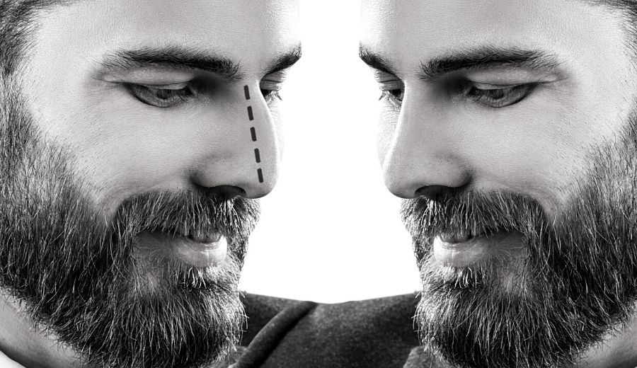 5 Important Tips to Keep In Mind After Rhinoplasty