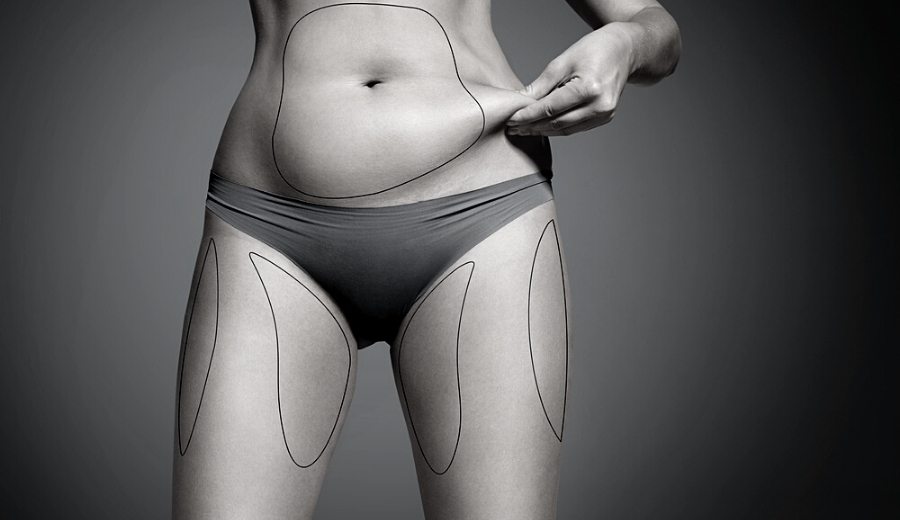 4 Things You Can't Do After Liposuction
