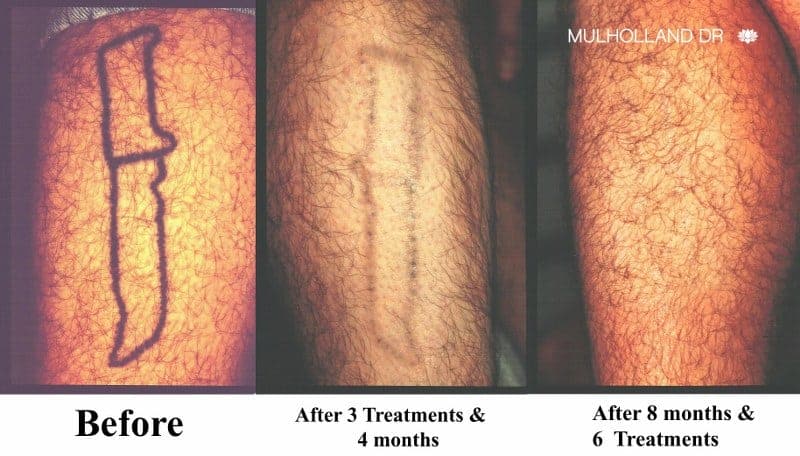 Laser Tattoo Removal Toronto - See Before & Afters | SpaMedica