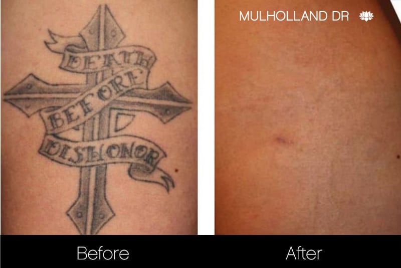 Did a Tattoo Removal Remedy Leave a Woman with a Scar  Snopescom