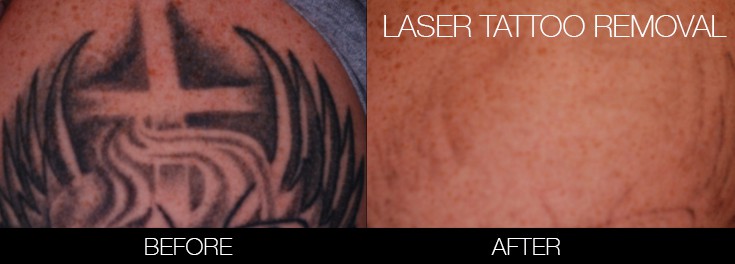PicoWay Laser Tattoo Removal in Toronto | SpaMedica