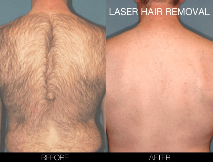 Laser Hair Removal Procedure in Toronto | SpaMedica