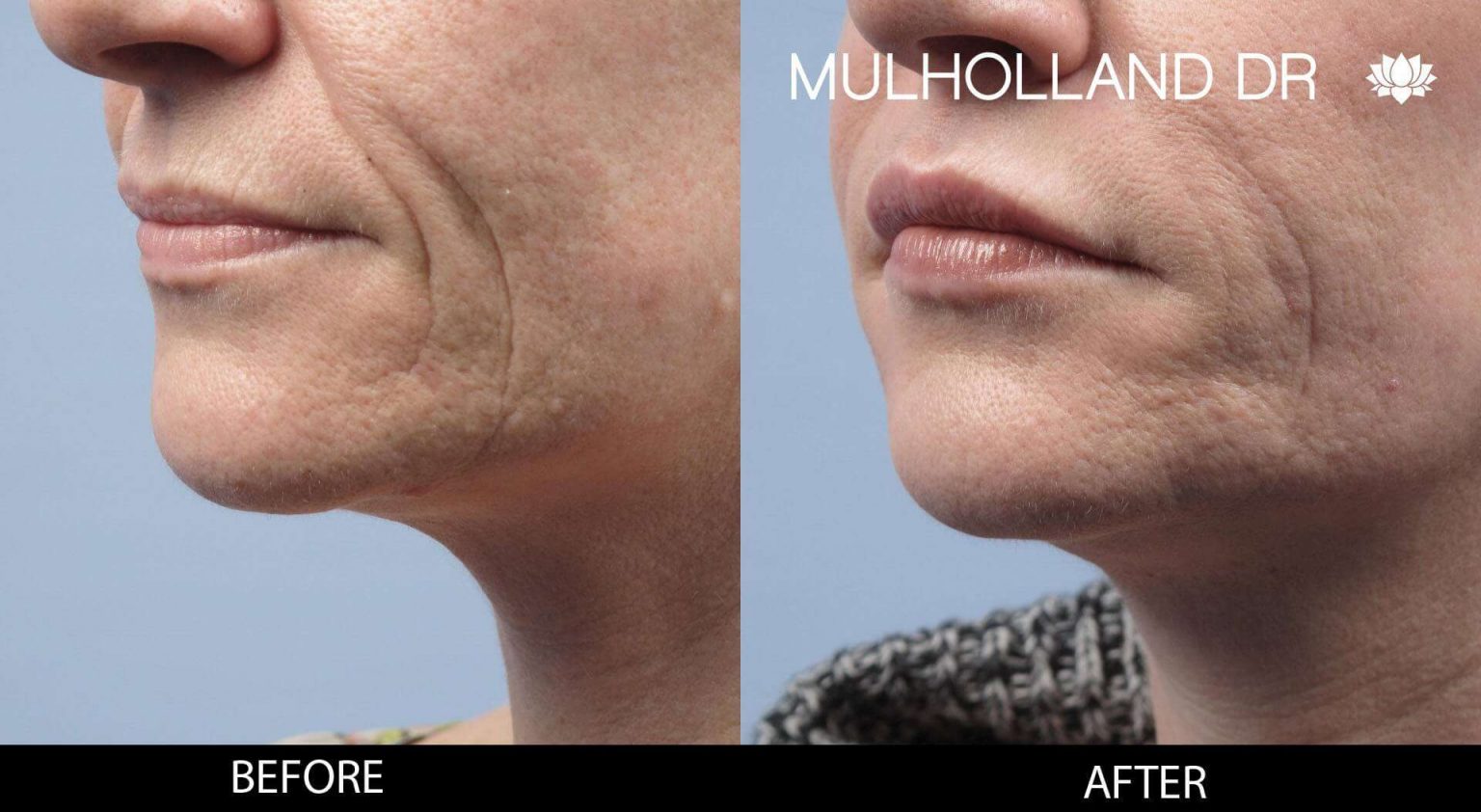 Best Lip Injections Toronto Lip Augmentation at SpaMedica