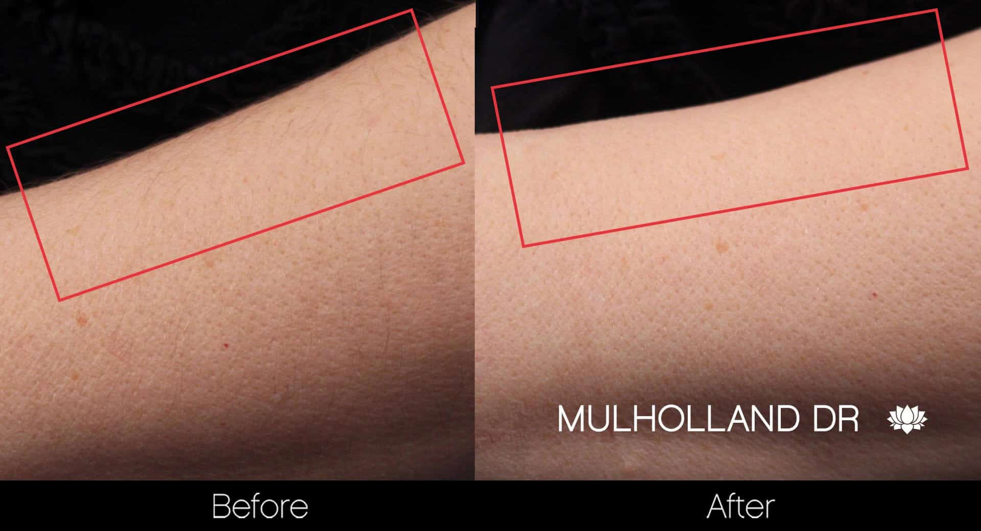 Laser Hair Removal - Patient Before and After Gallery – Photo 20