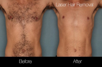 Laser Hair Removal Procedure in Toronto | SpaMedica
