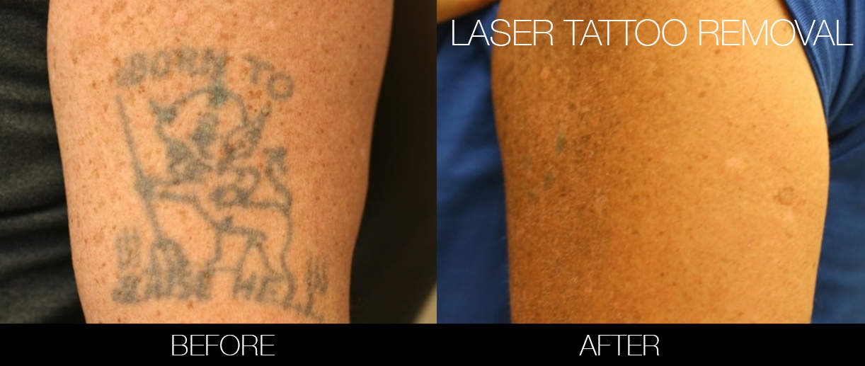 Laser tattoo removal st George salt lake city utah