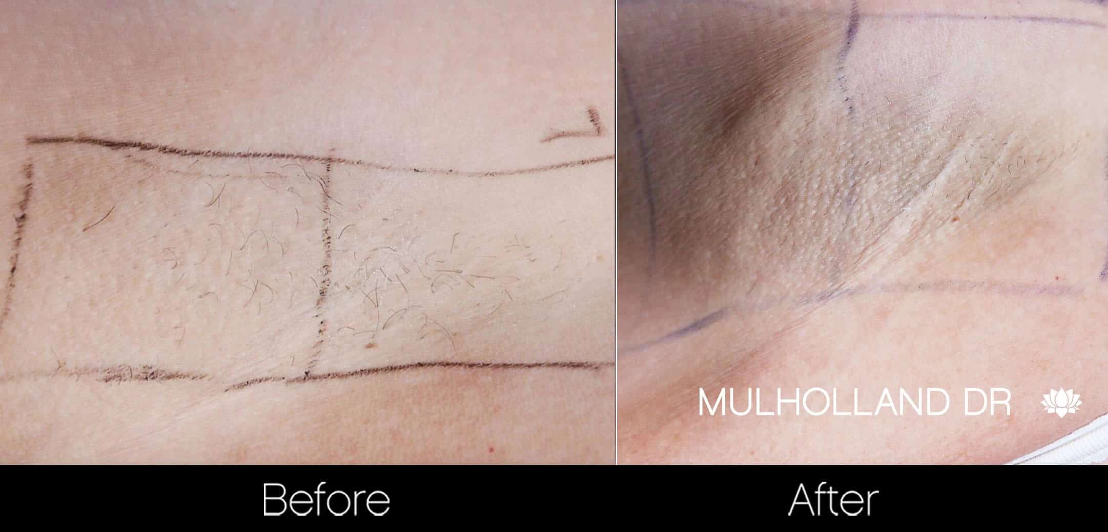 Laser Hair Removal - Patient Before and After Gallery – Photo 22