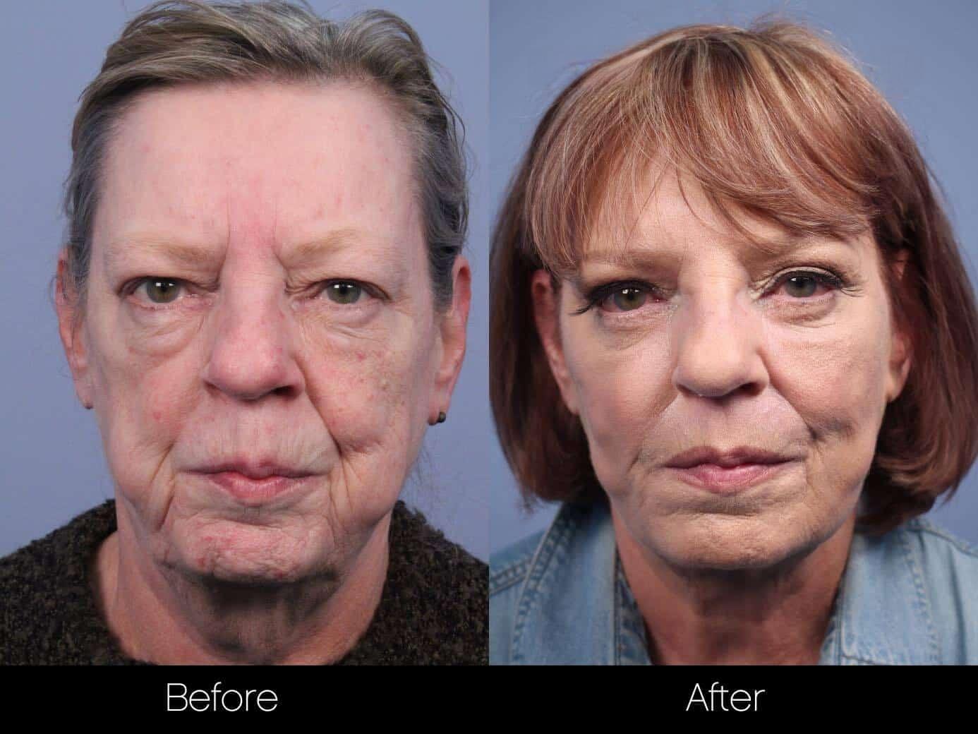 Morpheus8 - Patient Before and After Gallery – Photo 23