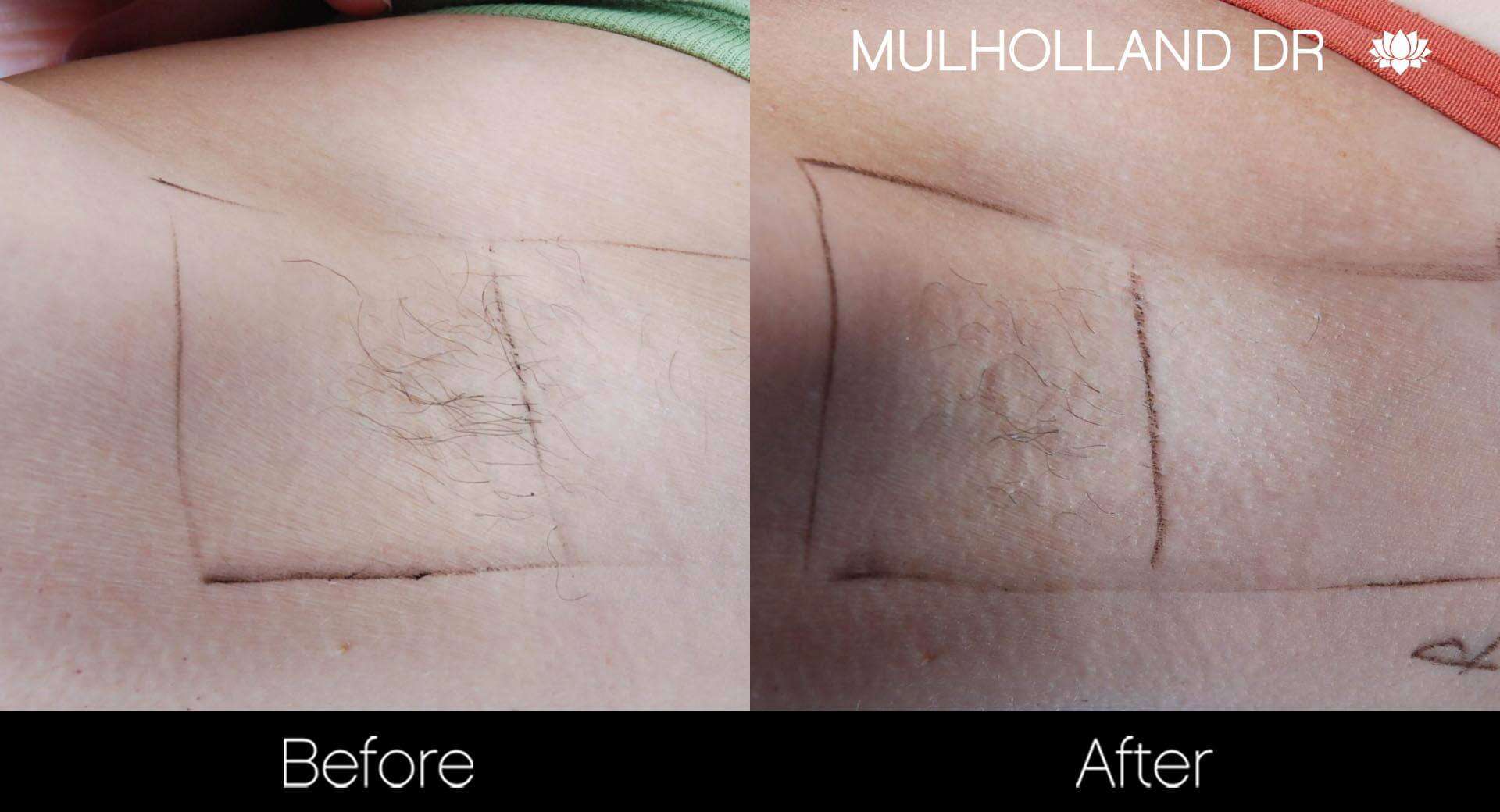 Laser Hair Removal - Patient Before and After Gallery – Photo 27