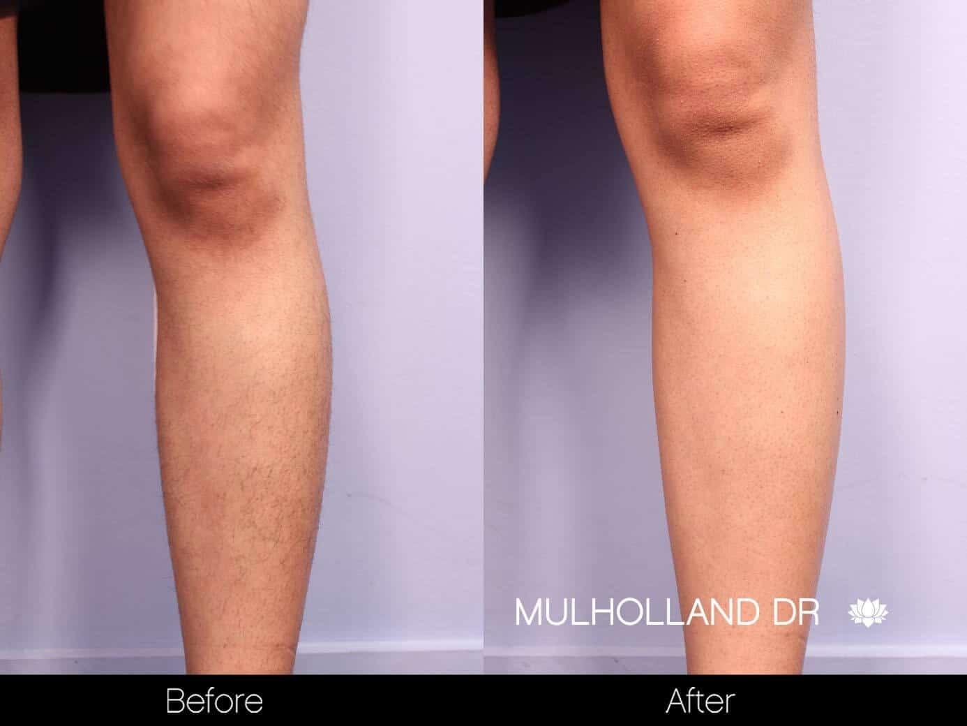 Laser Hair Removal - Patient Before and After Gallery – Photo 31