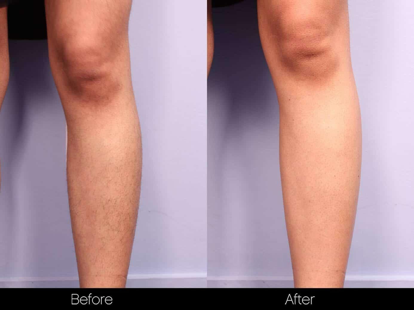 Laser Hair Removal - Patient Before and After Gallery – Photo 31