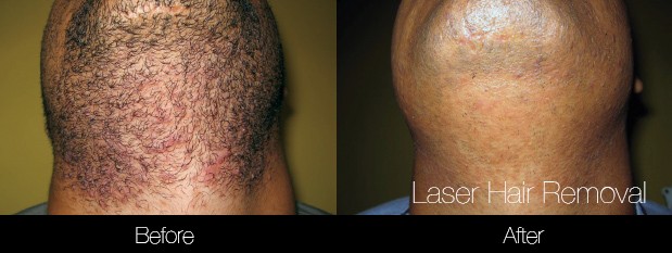 Laser Hair Removal - Patient Before and After Gallery – Photo 32