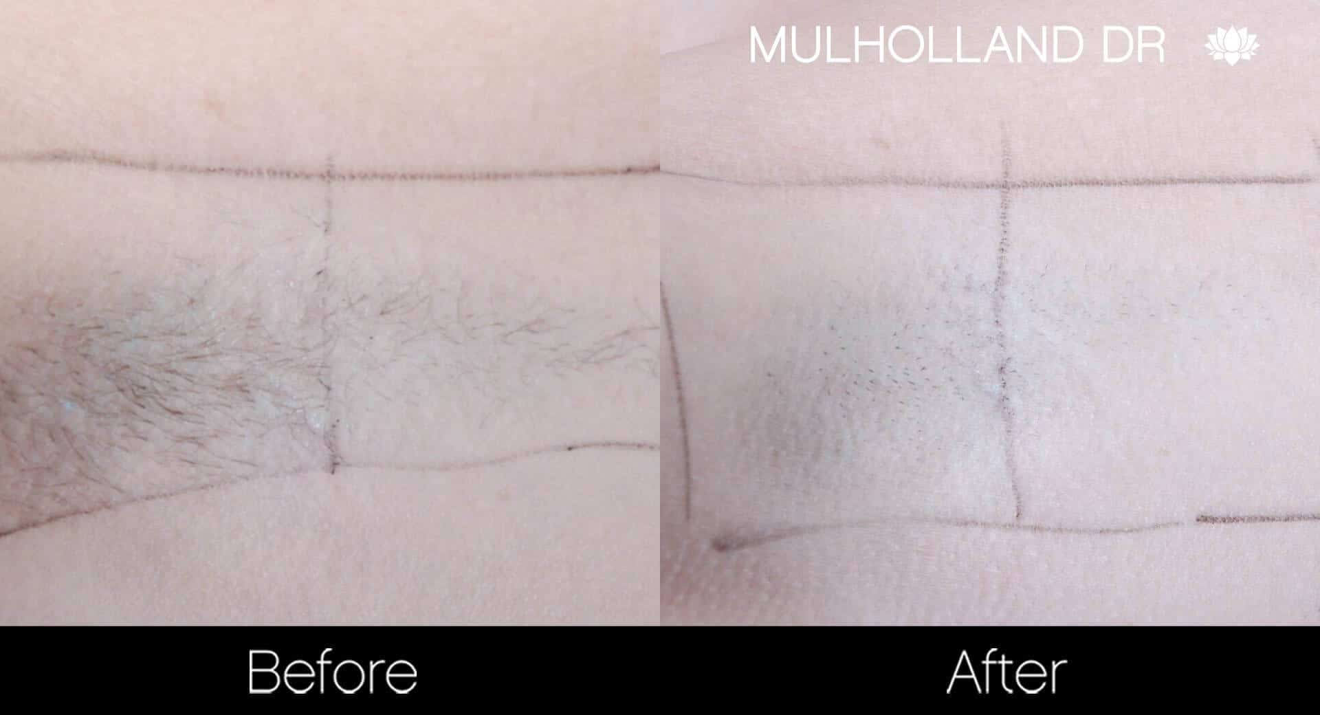 Laser Hair Removal - Patient Before and After Gallery – Photo 33