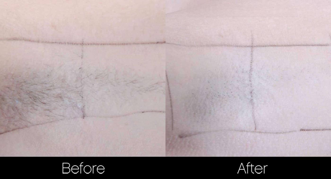 Laser Hair Removal - Patient Before and After Gallery – Photo 33