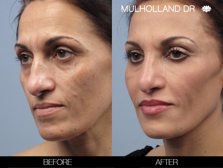 Laser Skin Resurfacing - Before and After Gallery – Photo 51